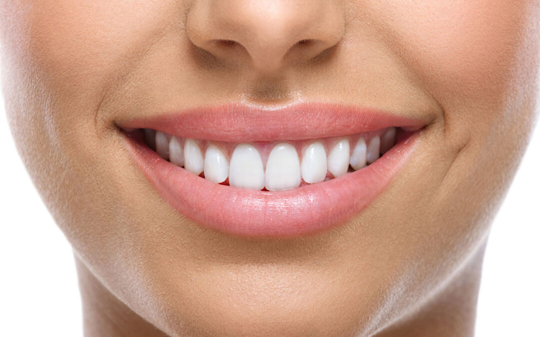 Lo sbiancamento dentale – Tutte le risposte che vorresti