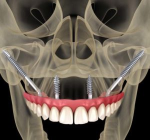 implantologia dentale con poco osso | Studio Dentistico Schenardi