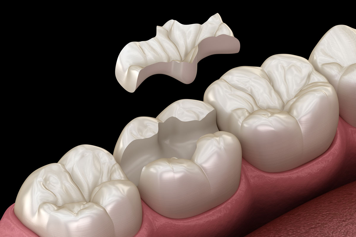 Render 3D intarsio dentale