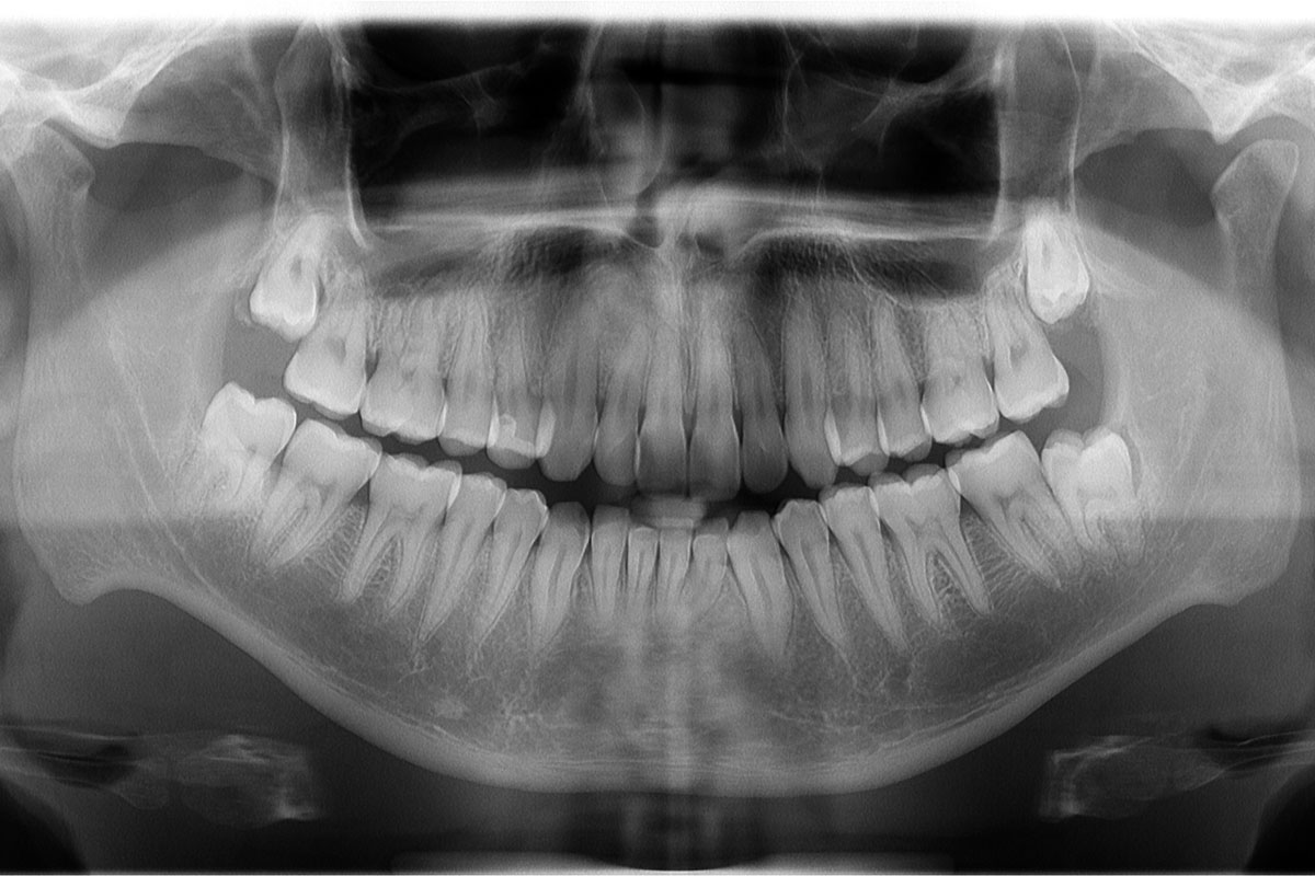 Radiografia denti