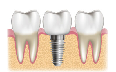 Hai perso un dente? Ecco perché aspettare troppo potrebbe complicare la situazione