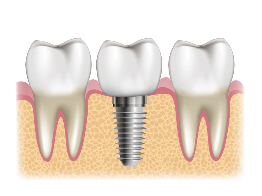 Hai perso un dente? Ecco perché aspettare troppo potrebbe complicare la situazione