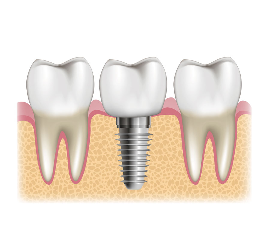 Impianti Dentali Render Impianti Dentali Render