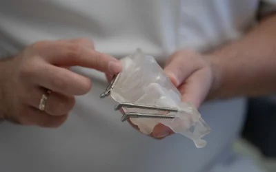 implantologia zigomatica: soluzione avanzata quando manca l’osso