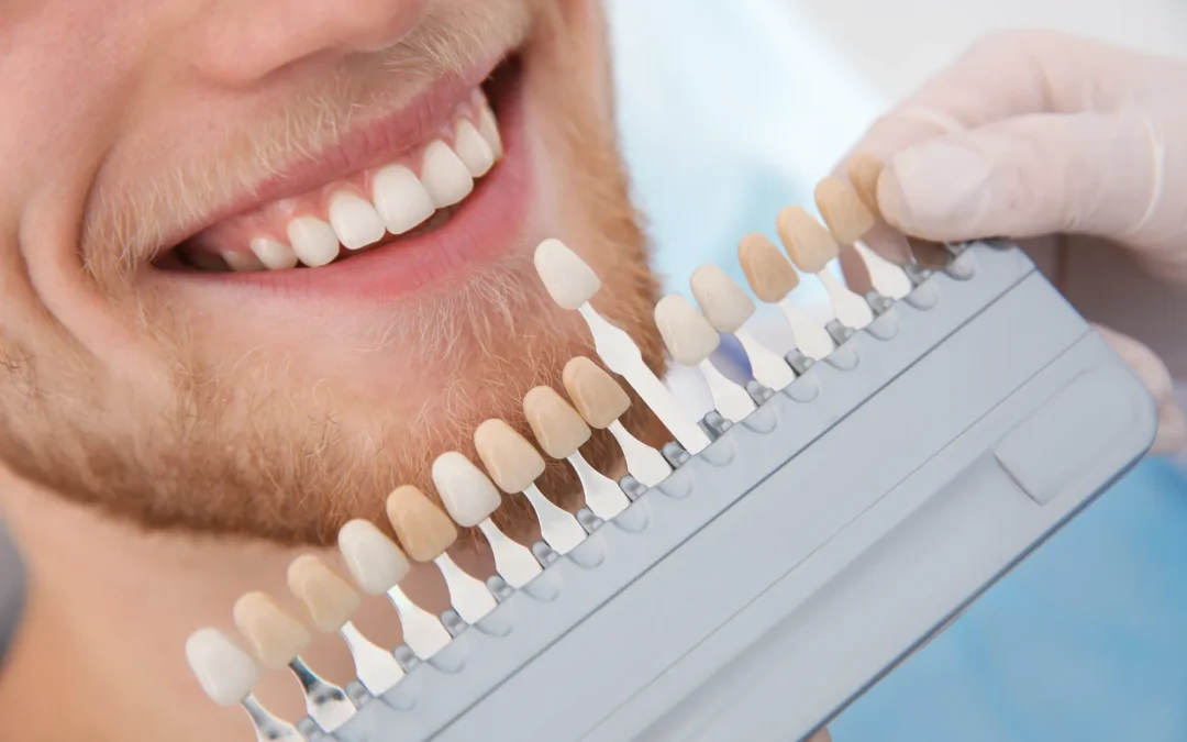 Estetica dentale a Conegliano: faccette dentali, indicazioni, vantaggi e limiti del trattamento