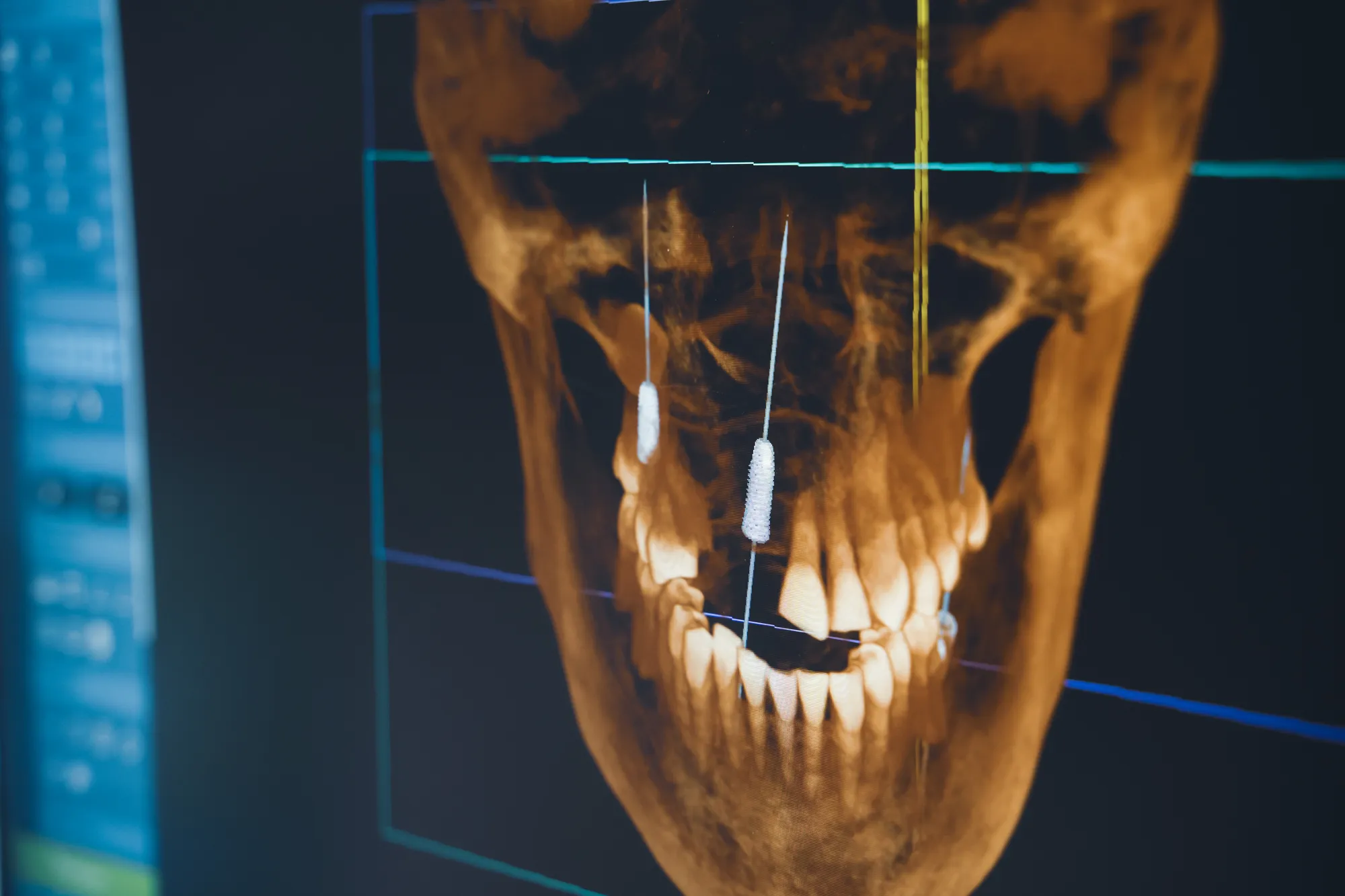 dental-radiography-x-ray-on-digital-screen-in-dent-2026-03-17-07-24-07-utc – Copia
