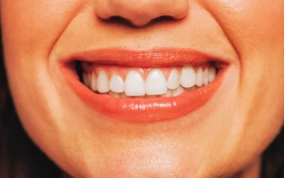 Sbiancamento dentale a Conegliano: trattamento sicuro ed efficace per denti più bianchi. Scopri benefici, durata e consigli del dentista.