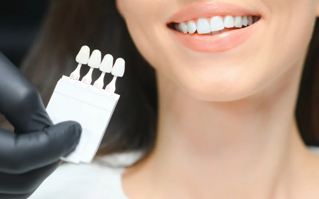 Faccette dentali: sono davvero la soluzione migliore per il tuo sorriso?