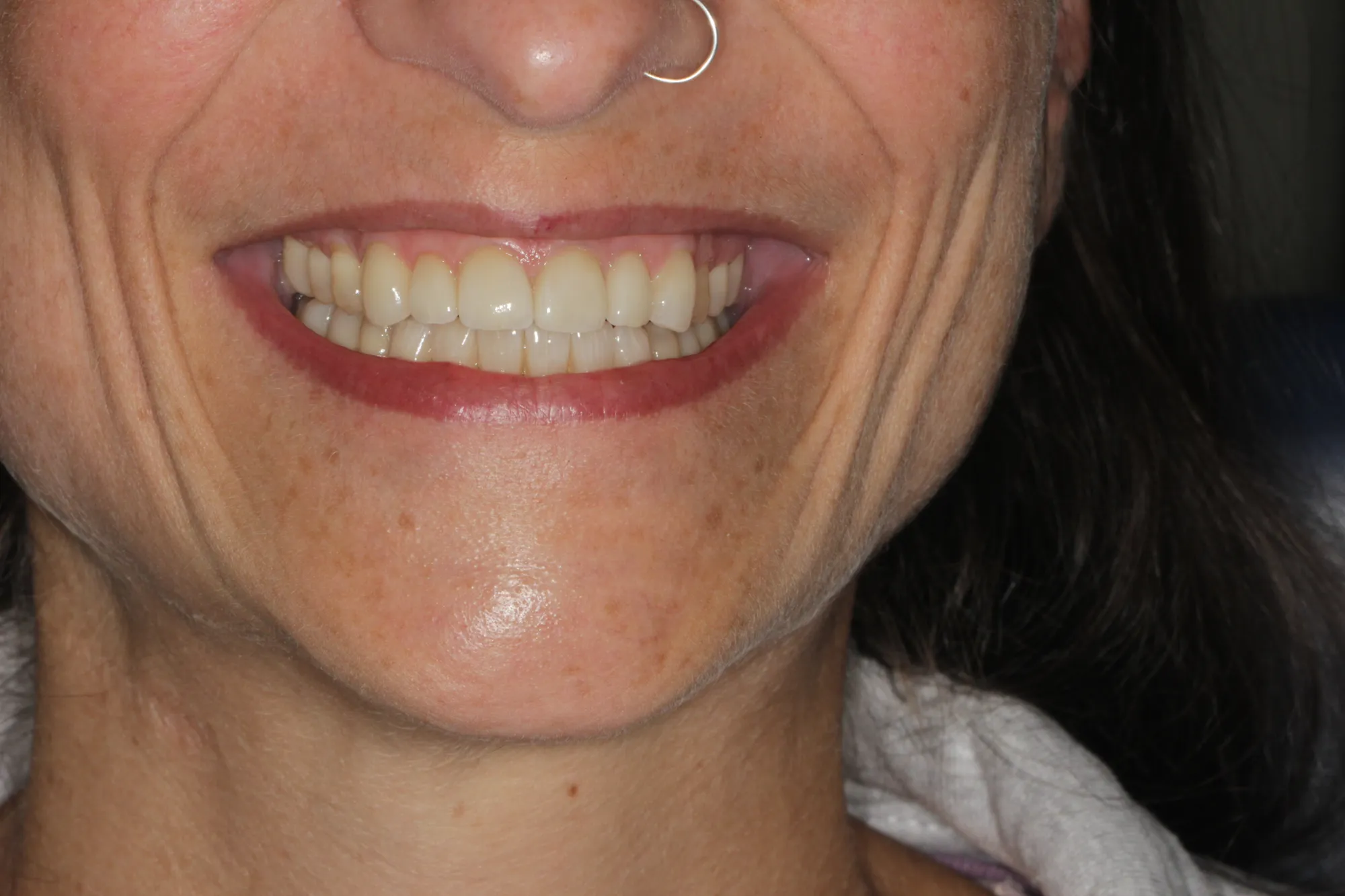 Sorriso dopo il trattamento di estetica dentale a Conegliano