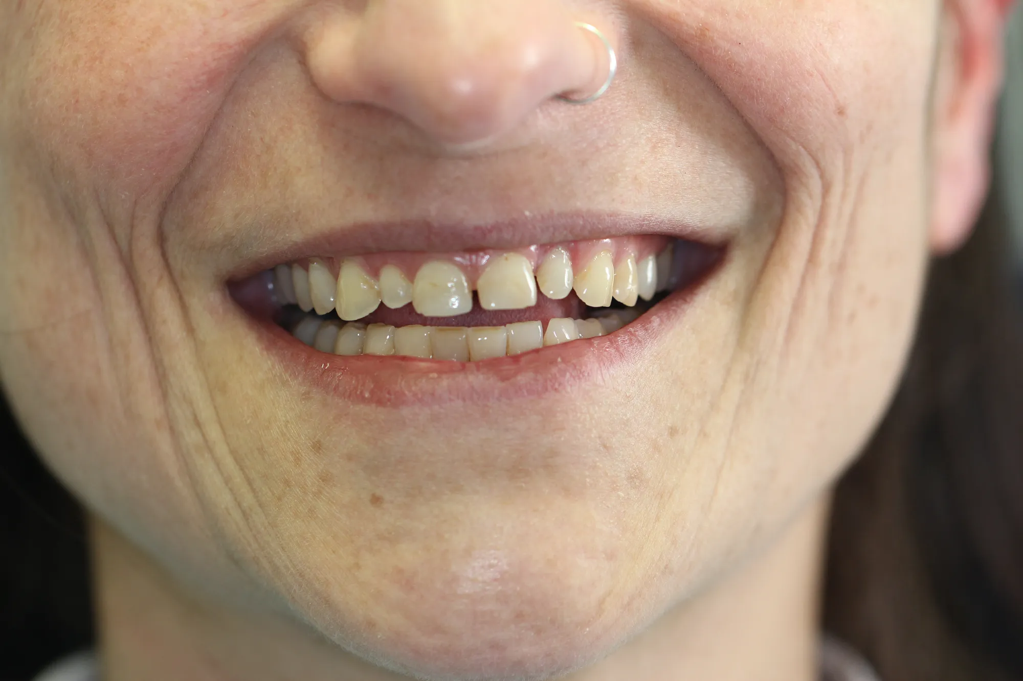 Sorriso prima del trattamento di estetica dentale