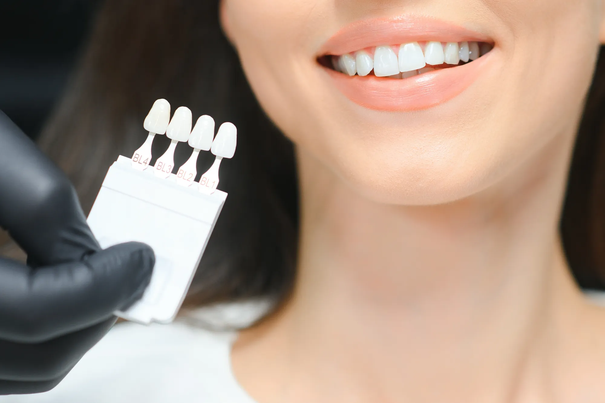 Faccette dentali sono davvero la soluzione migliore per il tuo sorriso