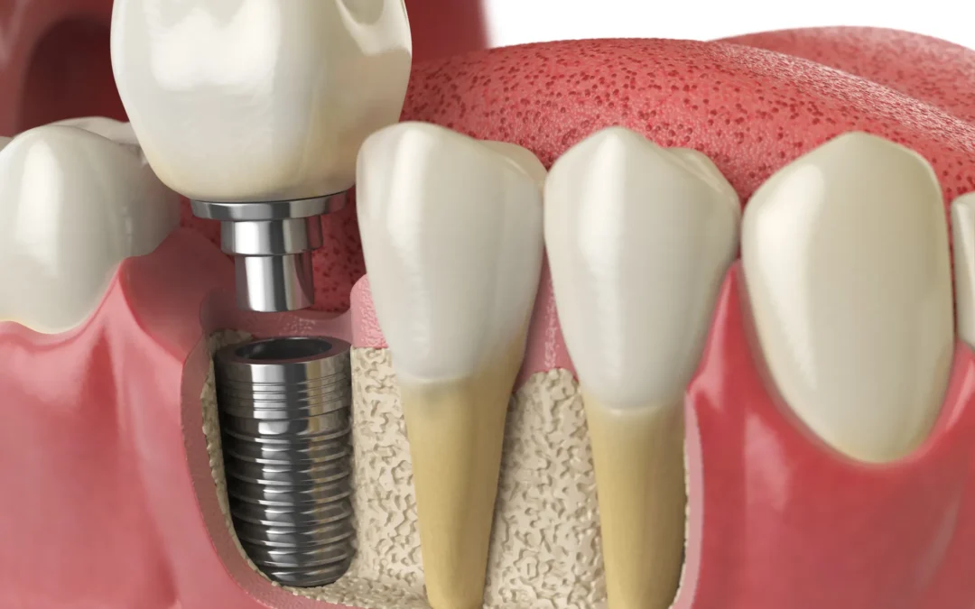 Impianto dentale o salvare il dente naturale? Come scegliere il trattamento più appropriato