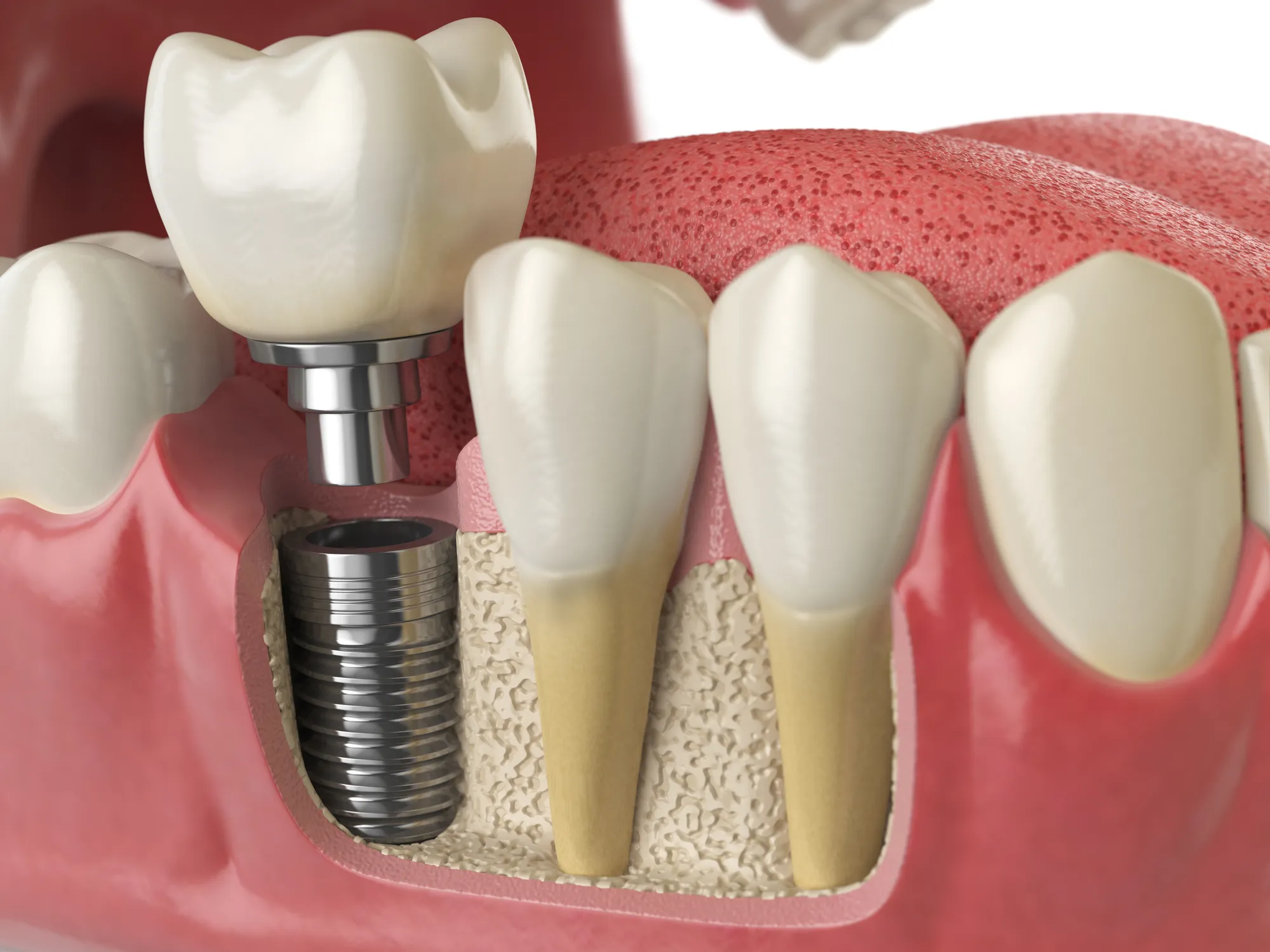 dental-implant-model-for-health-and-wellness-2026-09-22-00-25-12-utc